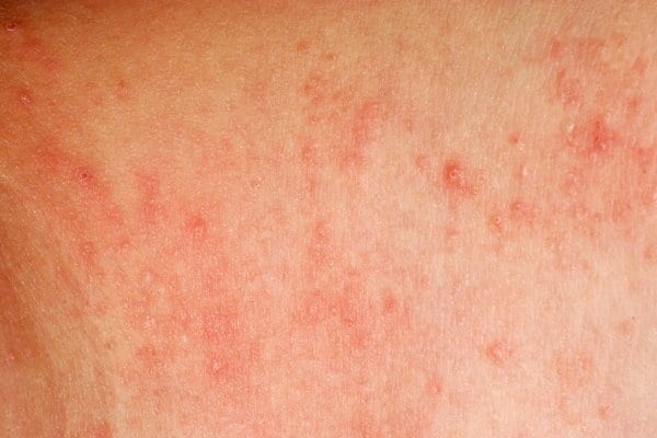Как выглядит аллергический дерматит