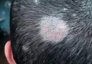 Дерматофития волосистой части головы
