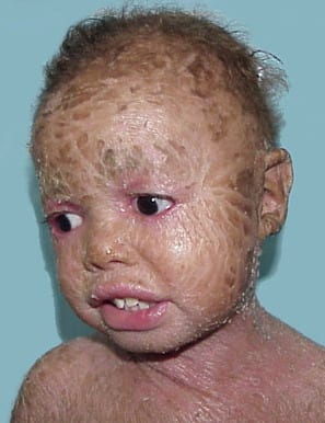 Ихтиоз кожи у детей