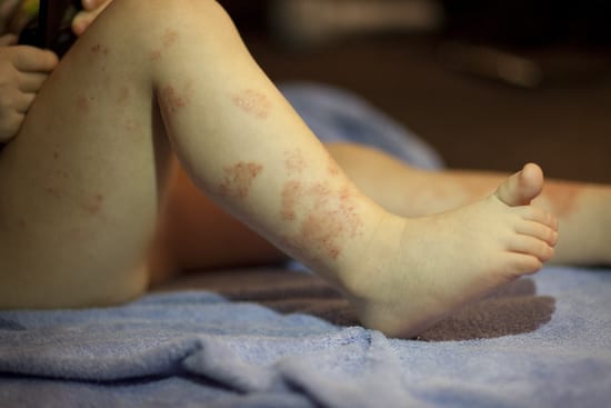 Кожные заболевания на ногах у ребенка