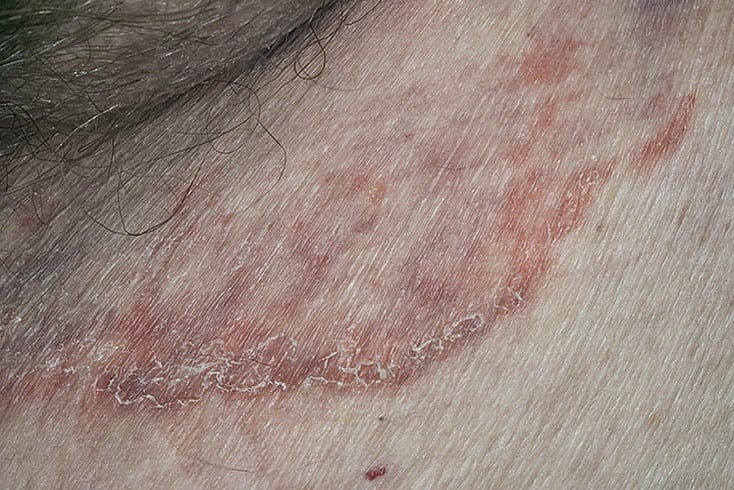 Паховая дерматофития на коже