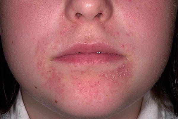 Как выглядит периоральный дерматит на лице
