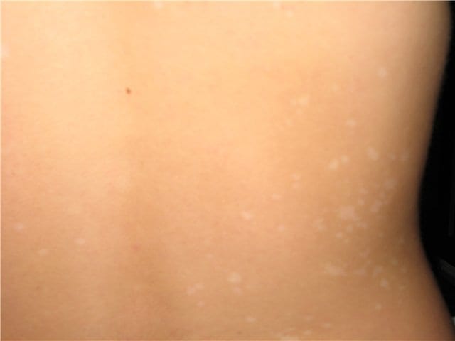 Как выглядят белые пятна на теле на нервной почве