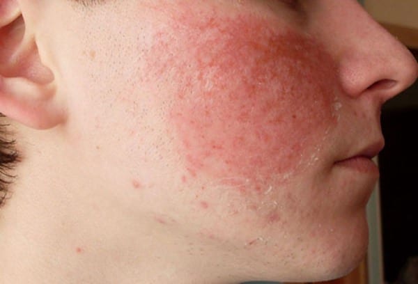 Реакция кожи на аллергический раздражитель