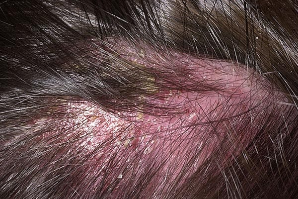 Смешанный себорейный дерматит волосистой части головы