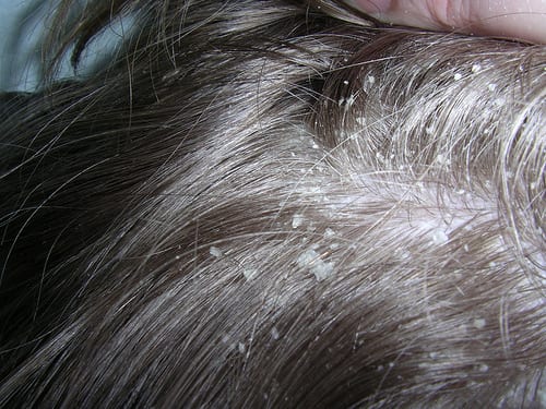Как выглядит себорея кожи головы у детей