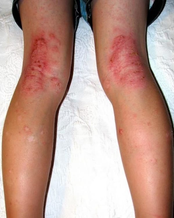 Венозный дерматит на ногах