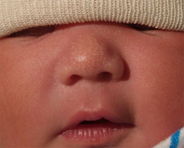 Жировик на носу у младенца