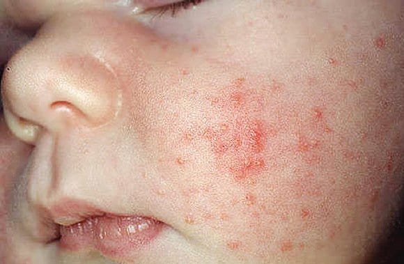 Пиодермия у детей на лице