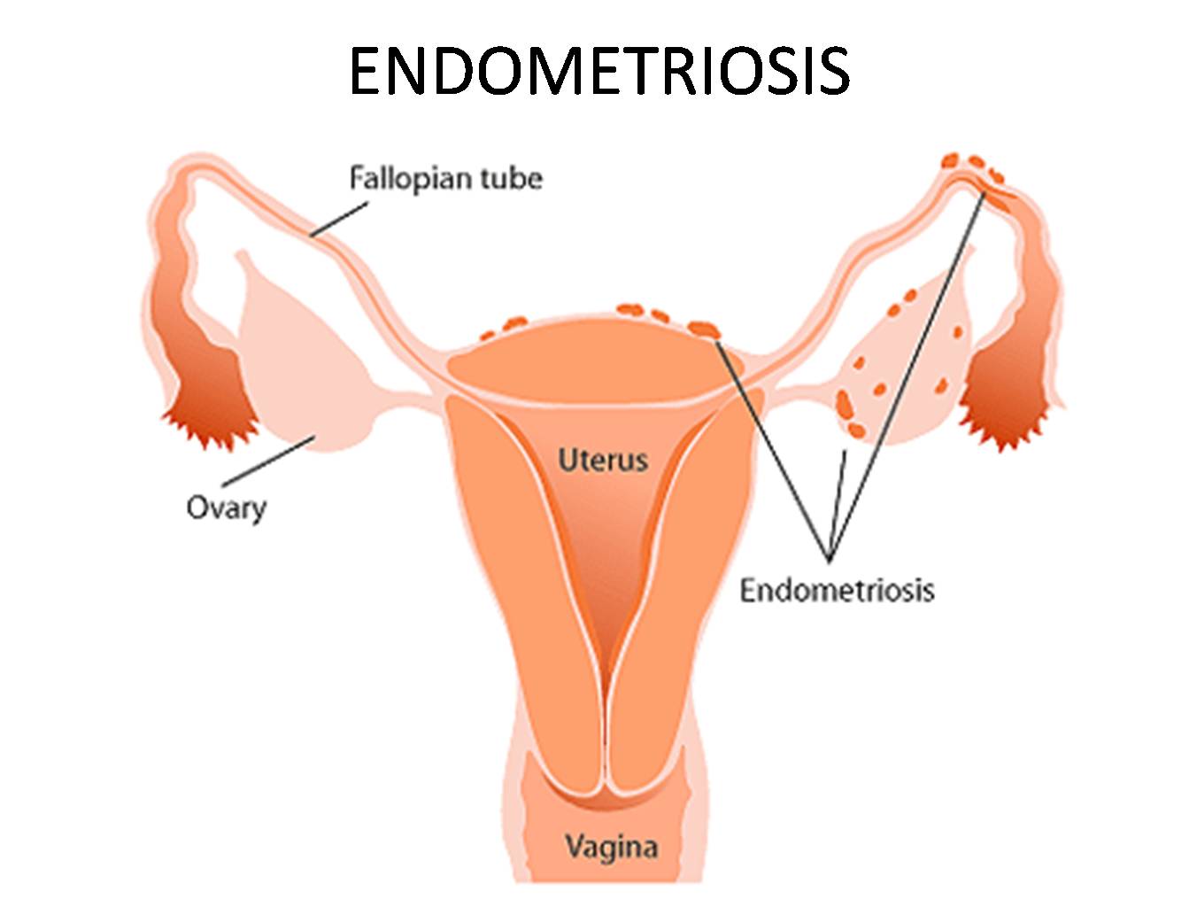 Эндометриоз маточных труб