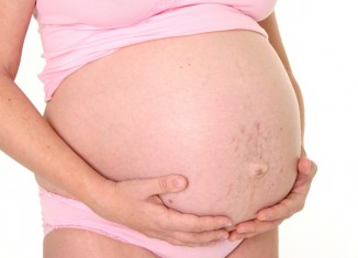 Как избавится от растяжек после беременности