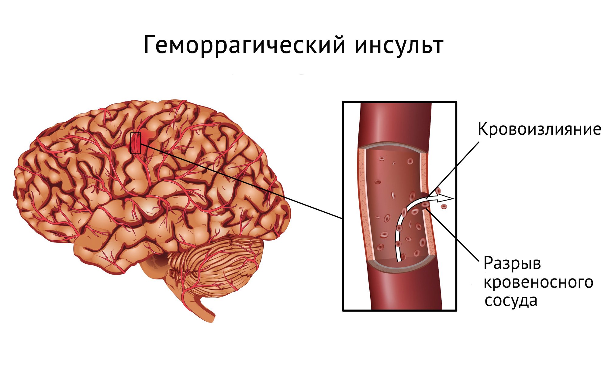 Лечение ишемического инсульта схема