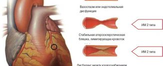 Инфаркт миокарда: причины, диагностика и лечение