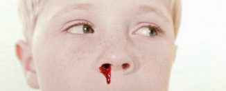 Носовые кровотечения у детей