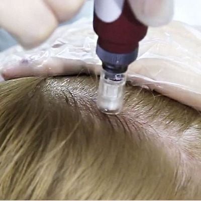 Мезотерапия для волос дома: как делать самостоятельно, советы