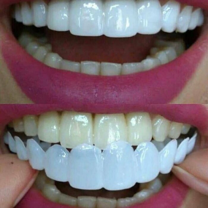 Керамические виниры: как делают, зубы до и после, плюсы и минусы, фото