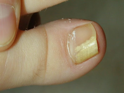 Деформация ногтя на большом пальце руки: причины, почему происходит