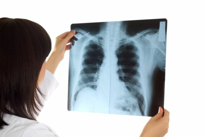 Разница между рентгеном легких и флюорографией: что лучше делать при пневмонии?