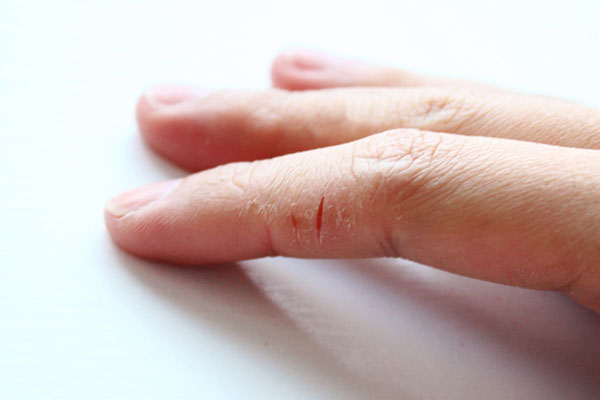 Как лечить глубокие трещины на пальцах рук: мазь для заживления кожи