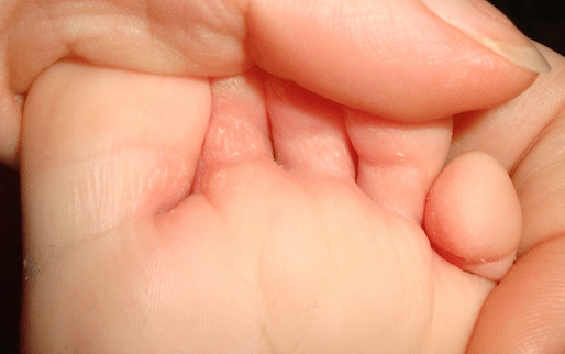 Почему трескается кожа между пальцами ног? Чем мазать трещины?