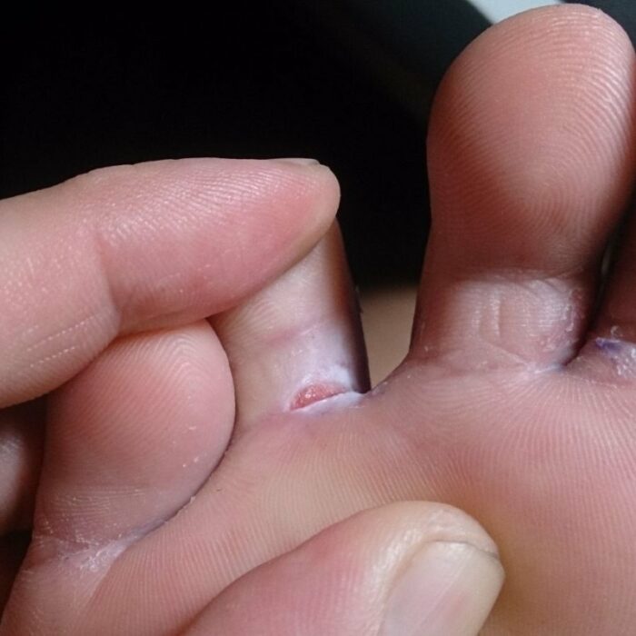 Почему трескается кожа между пальцами ног? Чем мазать трещины?