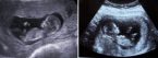 эхография сердца на 11 недели беременности