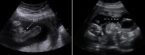 эхография сердца плода при беременности на 14 недели срока
