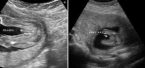 эхография сердца на 23 недели срока беременности