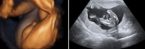 эхография сердца на 25 недели срока вынашивания ребенка
