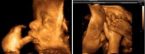 эхография сердца на 41 недели перед рождением ребенка