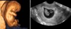 эхография сердца 9 неделя беременности